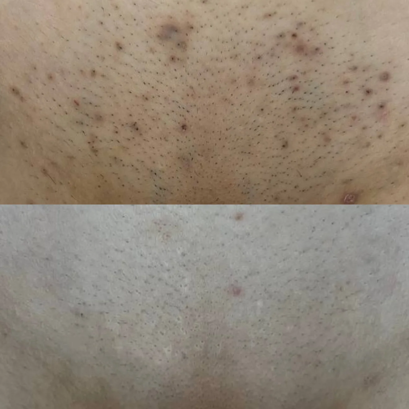 Before and after result 4 visits