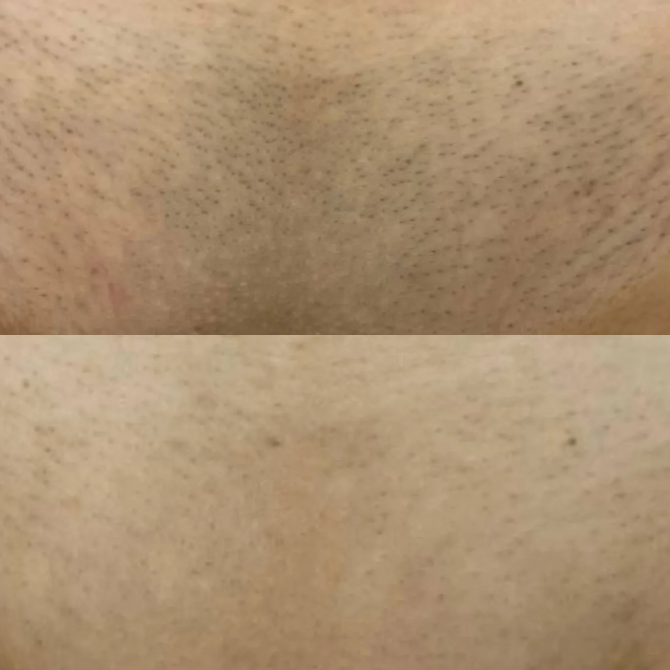 Before and after result 2 visits