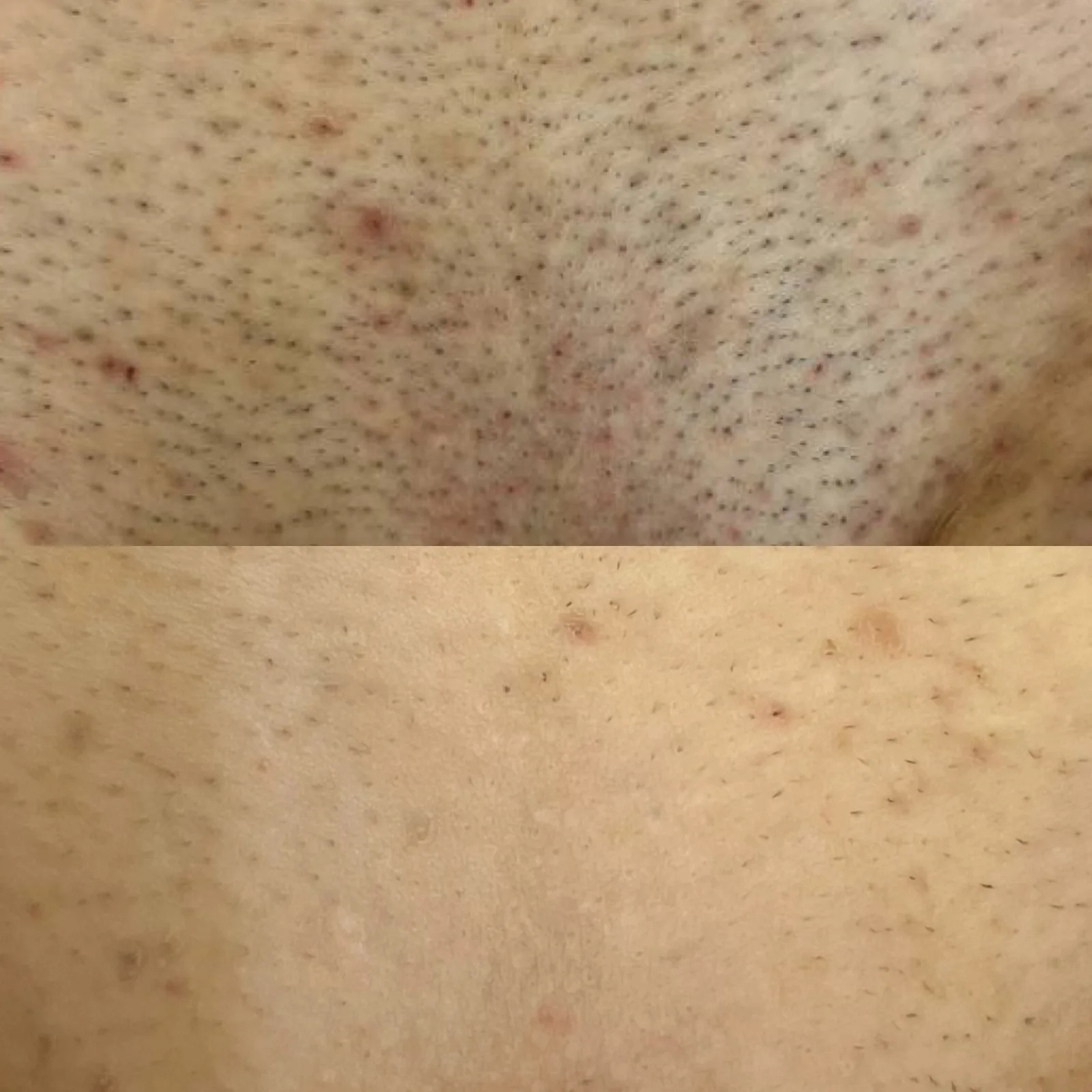 Before and after result 1 visit