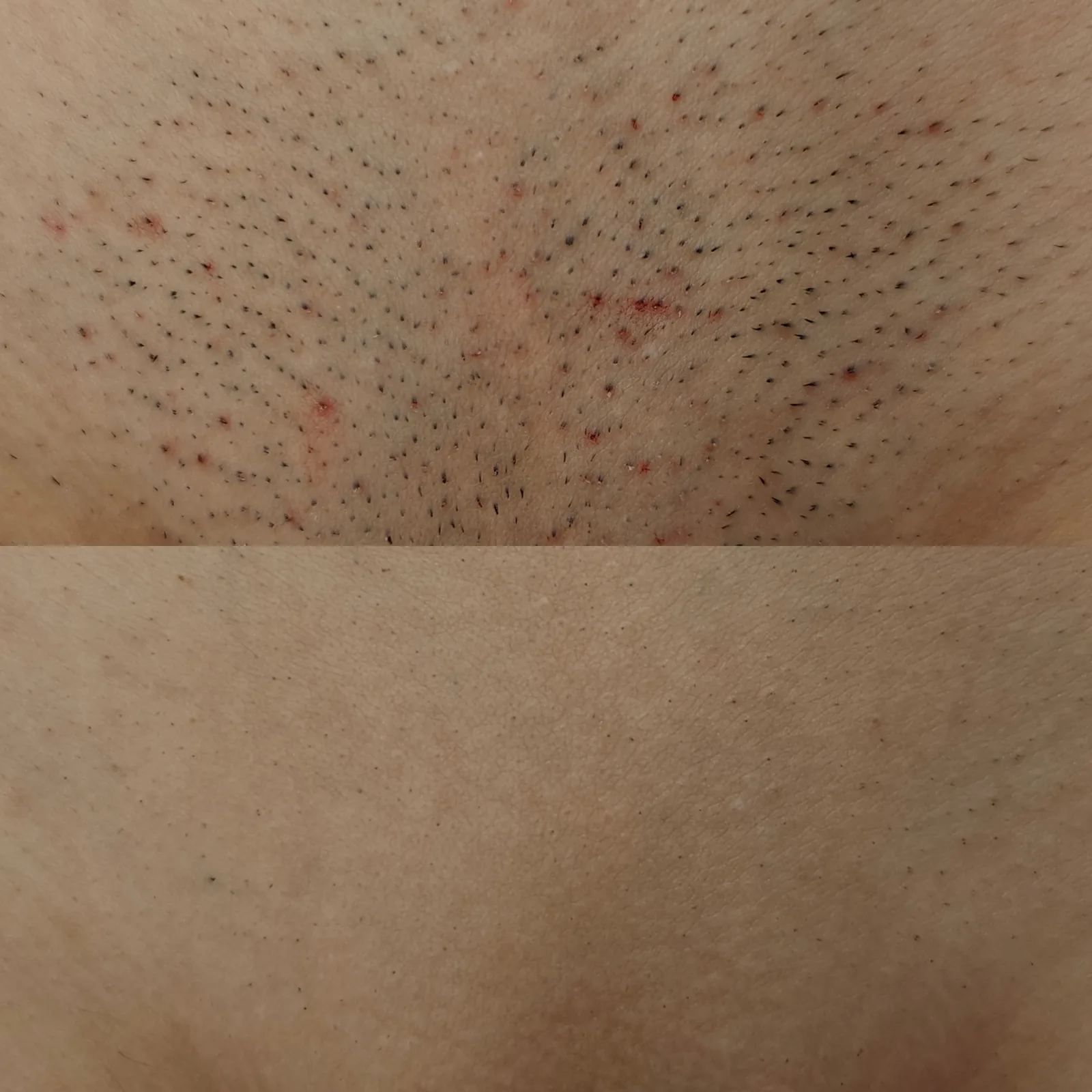 Before and after result 4 visits