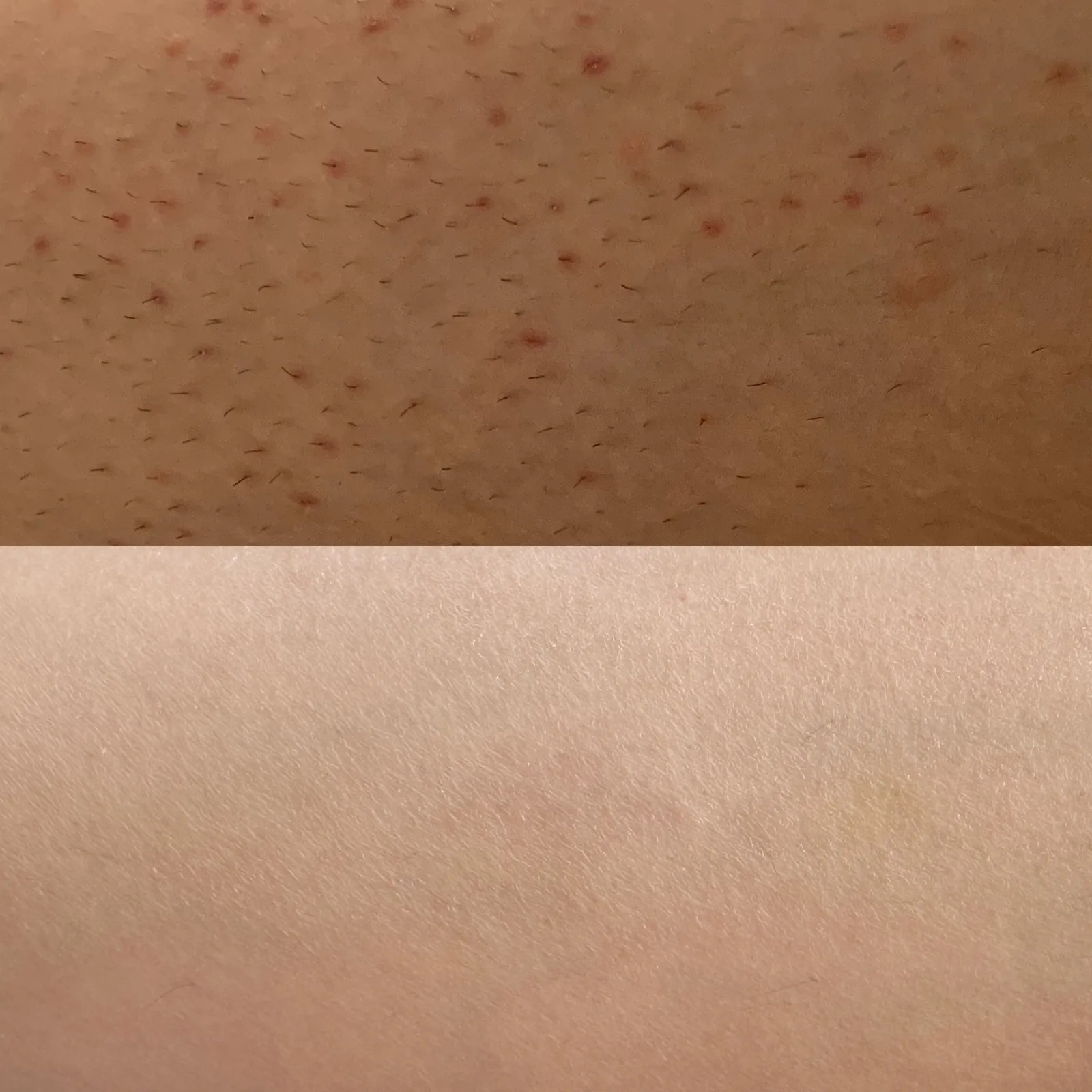 Before and after result 2 visits